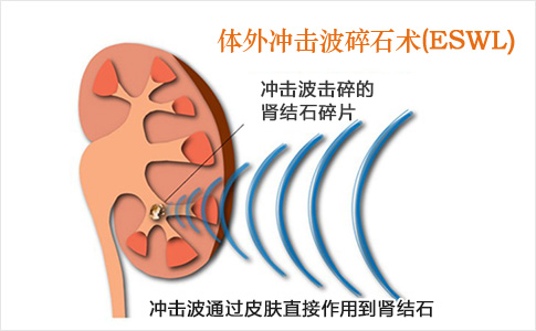 一分钟认识解肾结石(图3)