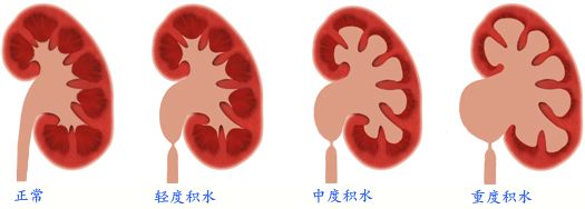 治疗肾积水办法这么多，哪种适合自己？(图1)