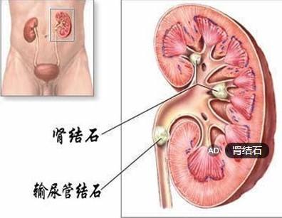 肾结石的检查方法有哪些？(图1)