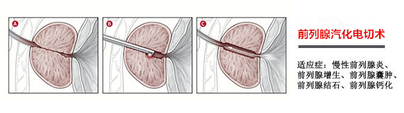 如何有效治疗前列腺增生？(图7)