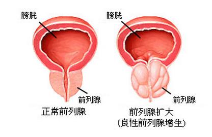 中医如何治疗前列腺增生？(图3)