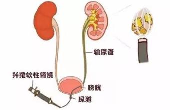 一次性给你们解答 关于肾结石碎石的疑问(图2)