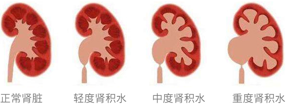 康复患者回答：四川治疗肾积水哪家医院好?(图1)