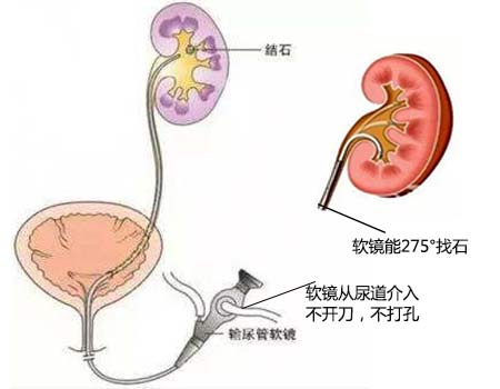 伤不起的肾结石 不止是疼痛而已(图3)