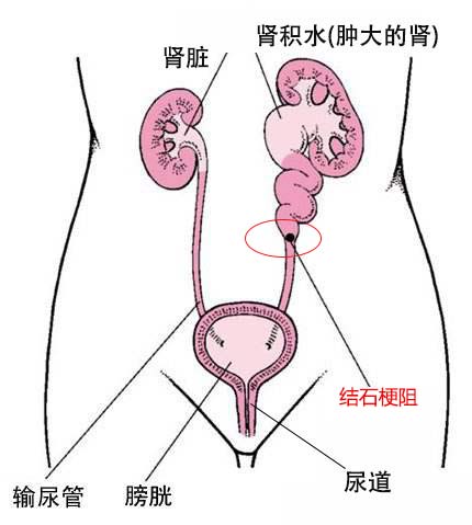 伤不起的肾结石 不止是疼痛而已(图2)