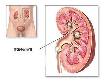 一分钟认识解肾结石(图1)