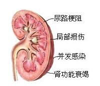 肾结石有哪些治疗方法(图1)