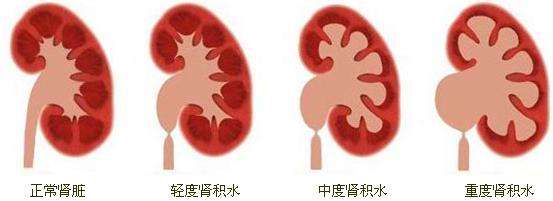 患者疑问：肾积水严重吗?(图2)