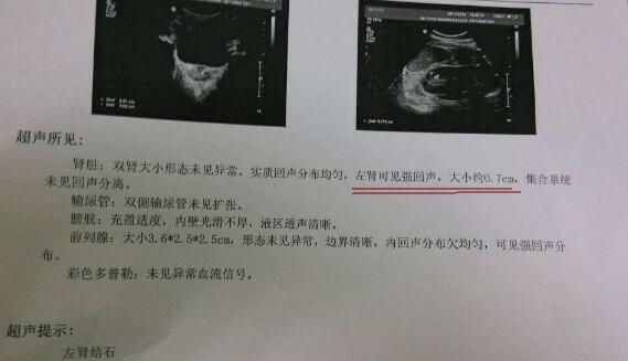 引起肾结石的4大因素，看看你是如何中招的(图1)