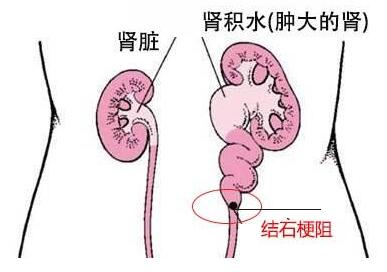 论肾结石排除方法的正确方式(图2)