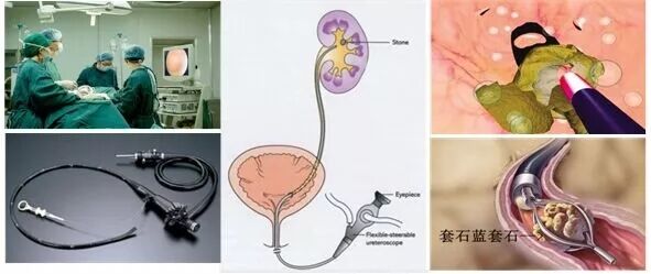 求支招！肾结石疼痛要怎么缓解？(图2)