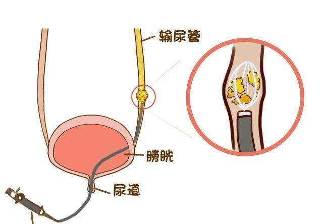 不开刀治疗尿道结石 恢复快(图1)