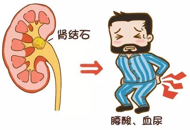 伤不起的肾结石 不止是疼痛而已(图1)