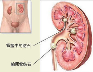 输尿管结石伴肾积水怎么办(图1)