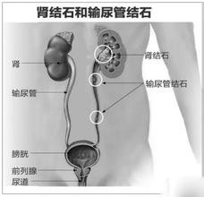 肾结石如何排出(图1)