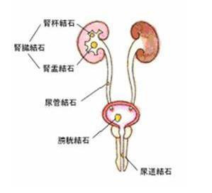 尿道结石的危害有多大 专家为您介绍(图1)