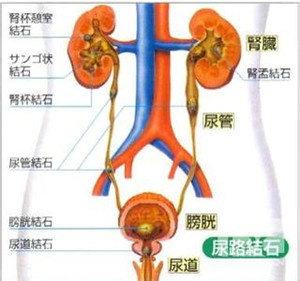 尿道结石对身体的危害有哪些？(图1)