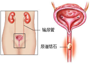 尿道结石如何治疗(图1)