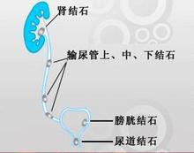 得了尿道结石能治疗好吗?(图1)