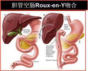 胆总管结石不及时治疗会引发哪些并发症？(图1)