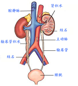 肾积水的病因您了解多少(图1)