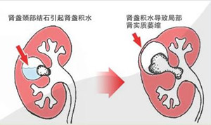 成都治疗肾积水的费用是多少？(图1)