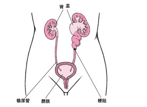 尿道结石的危害表现(图1)