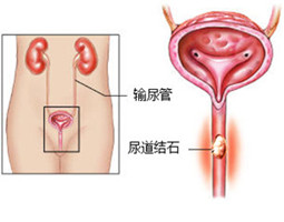 怎么治疗尿道结石好(图1)