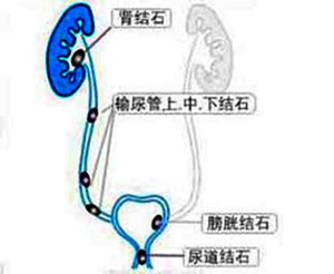 尿道结石体外碎石多少钱？(图1)