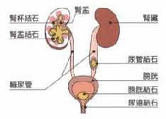 尿道结石怎么治疗(图1)