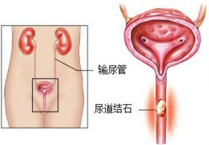 不开刀治疗尿道结石恢复快(图1)