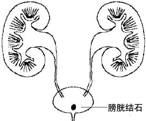 膀胱结石碎石费用需要多少?(图1)