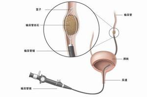 专家在线解答：肾积水的检查有哪些呢？(图2)