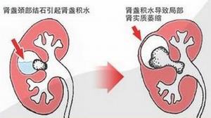 专家在线解答：肾积水需要手术治疗吗?(图1)