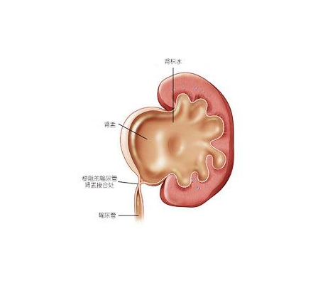 专家在线解答：肾积水的形成原因是什么？(图1)