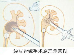 肾结石微创治疗让您的结石不再来(图1)