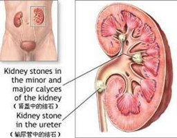 怎么治疗输尿管结石效果好(图1)