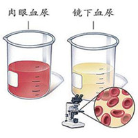 输尿管结石可以不治疗吗？(图1)