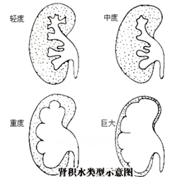 输尿管结石可以不治疗吗？(图2)