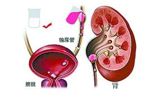 输尿管结石可以保守治疗吗?(图1)