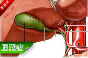 胆固醇胆囊息肉的危害有哪些？(图1)