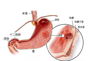 胆囊切除的八大后遗症(图2)