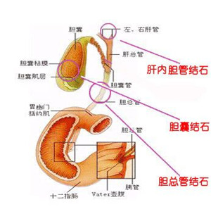 肝内胆管结石(图1)