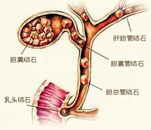 肝内胆管结石的病因是什么？(图1)