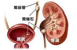 专家解析：什么是输尿管结石？(图1)