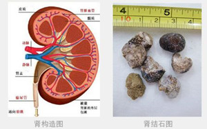 肾结石小百科(图1)