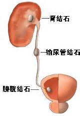 膀胱结石是怎么形成的(图1)