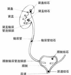 输尿管结石形成的原因是哪些(图1)