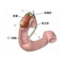 胆总管结石的病因是哪些(图1)