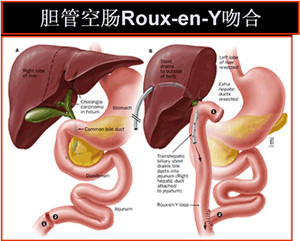 胆总管结石的病因是哪些(图2)